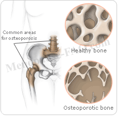 differences between normal and osteoporosis bone